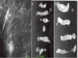 01- Mamography